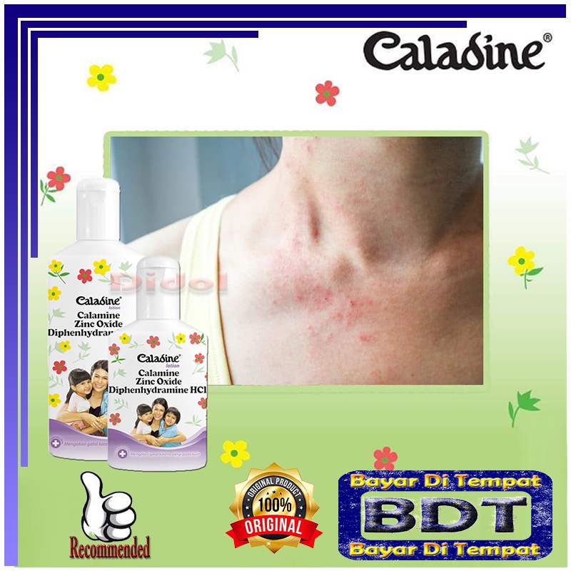 Caladine Cair Penghilang Dan dan Alergi Di Kulit Caladine Lotion Untuk Dewasa Bedak Gatal Paling Amp
