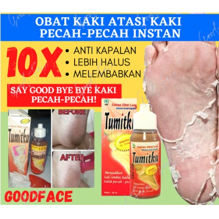 TUMITKU MENGATASI KAKI PECAH 30ML / TUMITKU OBAT HERBAL MENGATASI KAKI PECAH PECAH KAPALAN /  Tumitk