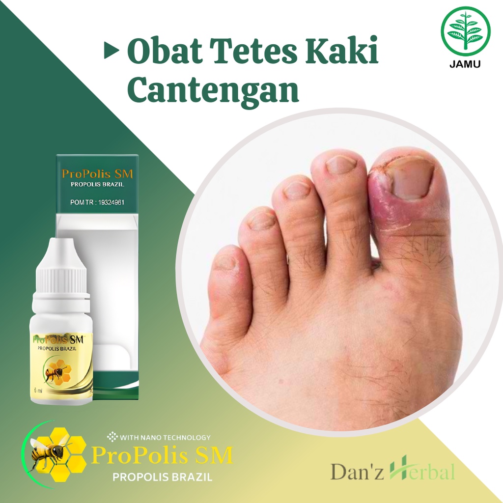 Obat Jempol Kaki Cantengan, Cantengan di Tangan & Kaki, Tetes Cantengan, Kuku Bengkak, Nyeri, Kuku N