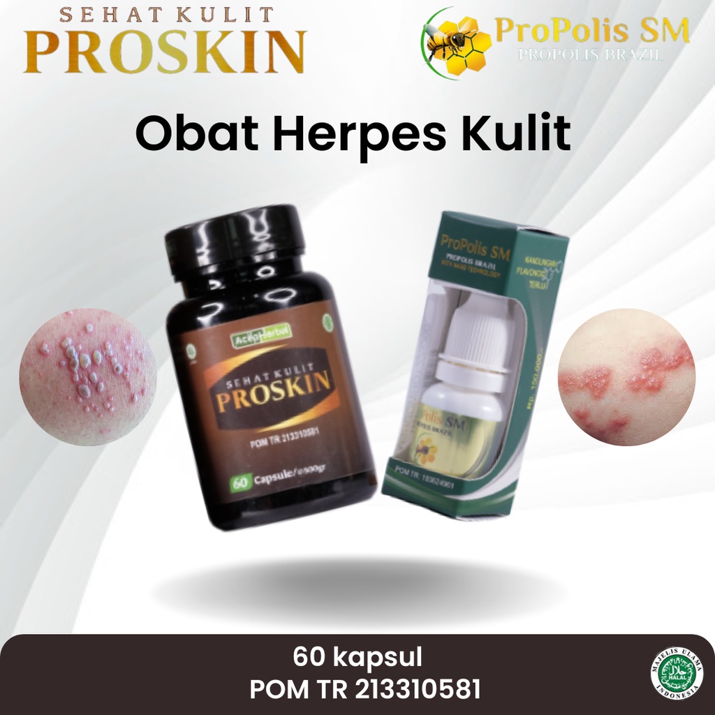 Obat Herpes, Penyakit Herpes, Herpes di Kelamin, Herpes Zoster, Herpes Genital, Herpes Kulit, Herpes