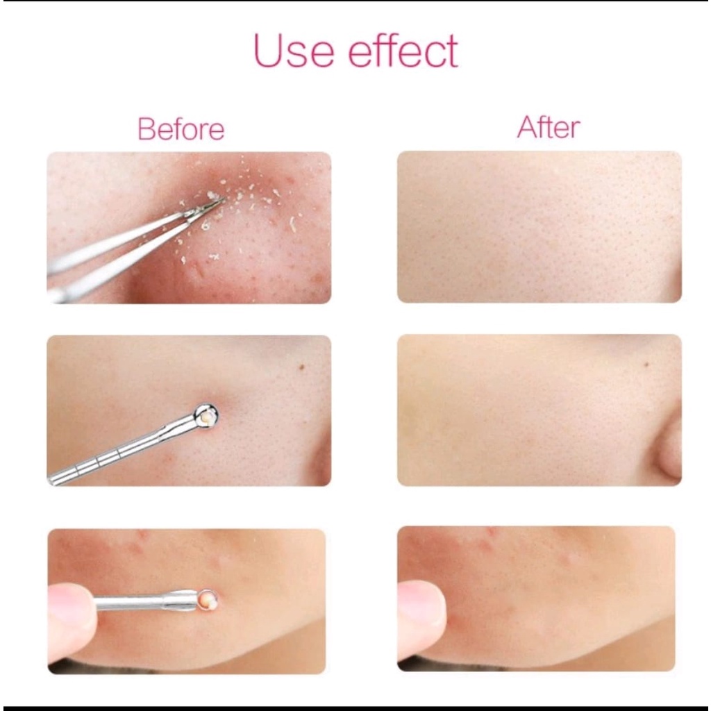 Alat Pinset Pencet Komedo Pembersih Jerawat Acne Blackhead 3 in 1