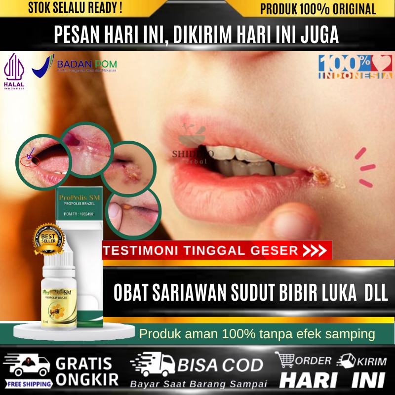 Obat Sariawan Di Sudut Bibir Anak dan Dewasa, Obat Tetes Pinggir Bibir Luka, Salep Oles Luka Di Sudu