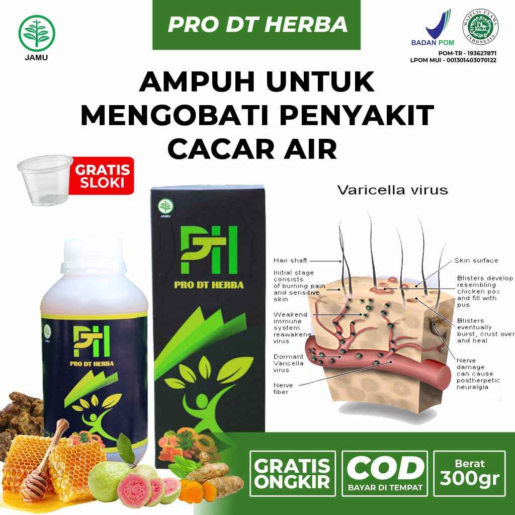 Obat cacar air paling ampuh, cacar air ampuh anak, cacar air ampuh dewasa, cacar air untuk bayi 2 ta