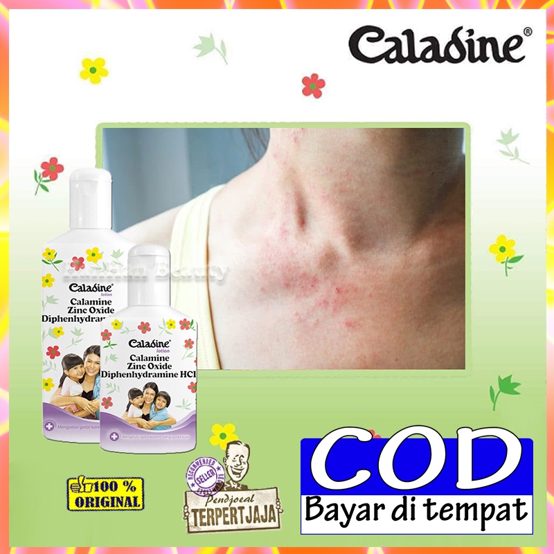 Caladine Lotion 60ml Dan 95ml Mengatasi Biang Keringat Bedak Gatal Gatal Pada Kulit Dewasa Caladine 
