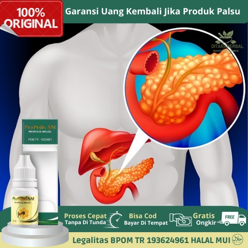 Obat pankreatitis, Obat Radang Pankreas, Obat Pankreatitis Akut, Obat Pankreatitis Kronis, Obat Nyer