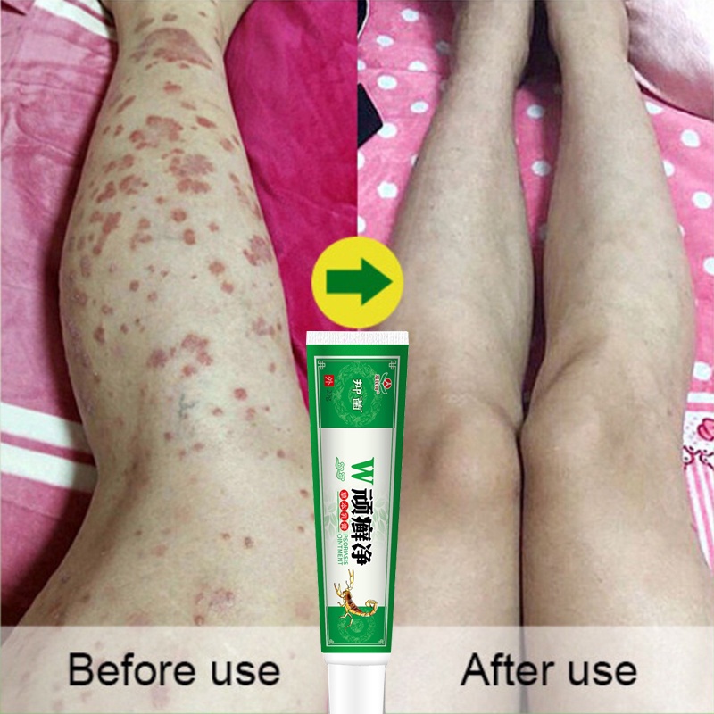 Salep obat kulit gatal Gatal - Obat Gatal Selangkangan Eksim Dan Jamur Budug Bernanah Scabies Manusi