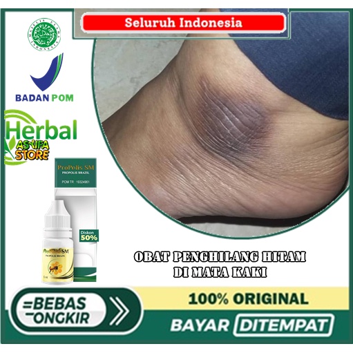 Obat Penghilang hitam di mata kaki, kapalan, bekas luka, kaki bengkak, Salep Cair penghilang bekas k