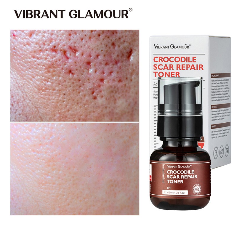 [COD] VIBRANT GLAMOUR Crocodile Scar Repair Face Toner Serum Krim penghilang luka bekas Menghilangkan 30ml Acne Scar Removal Whitening Dark Spots Stretch Marks Treatment