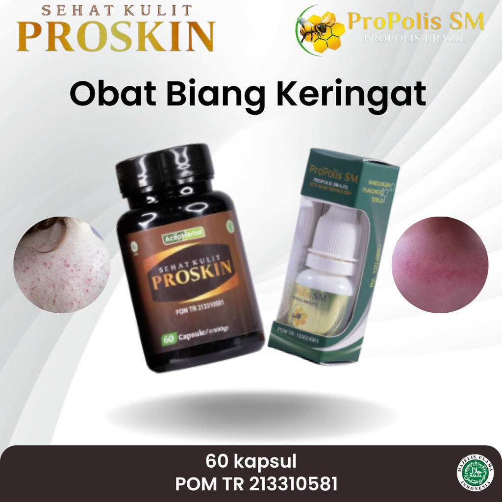 Obat Biang Keringat, Miliaria Rubra, Gatal Kulit, Gatal Seluruh Badan, Kaligata, Biduran, Bintik Bin
