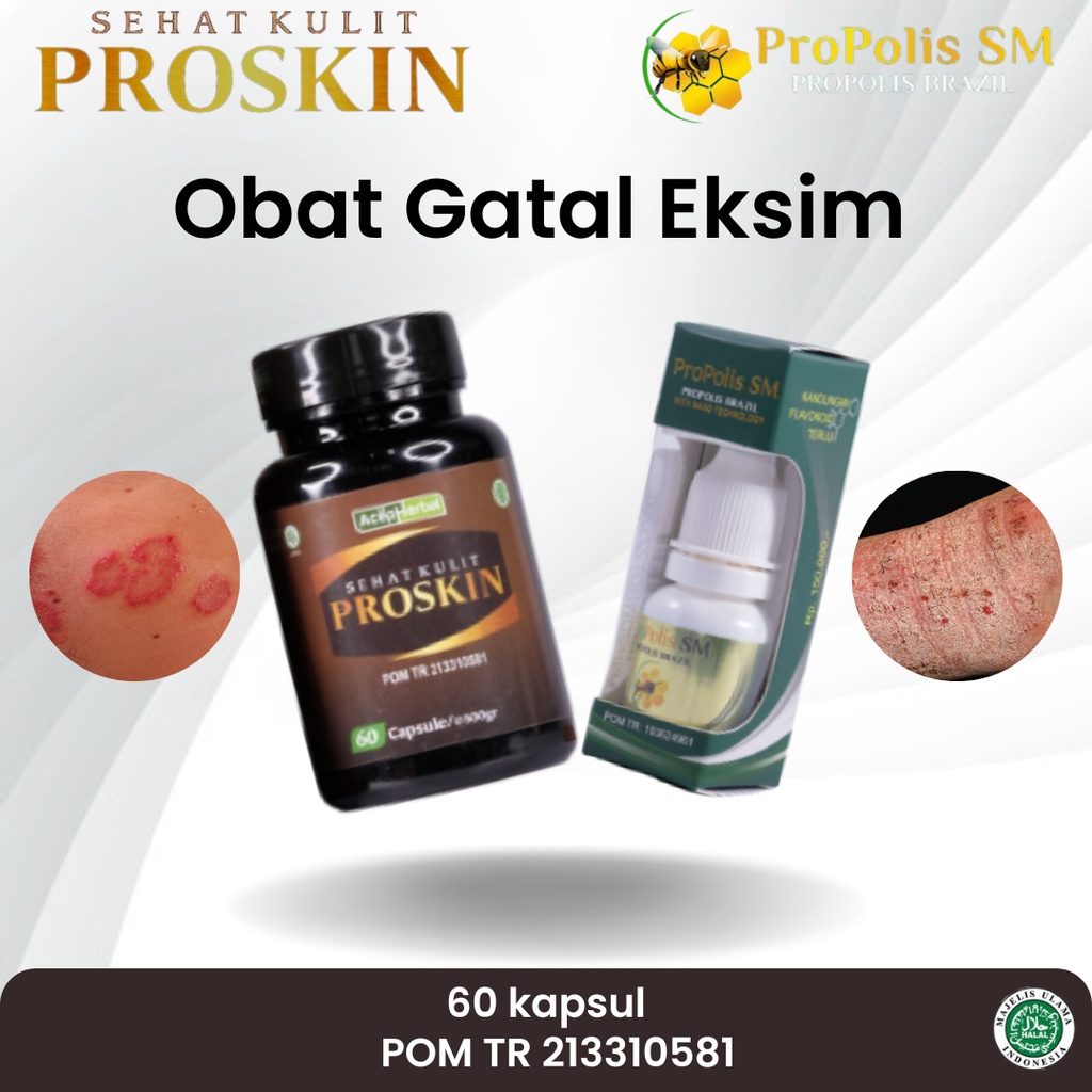 ProPolis SM - Obat Eksim Kering, Eksim Di Kaki, Gatal Exsim, Eksim Basah, Salep Eksim, Eksim Parah, 