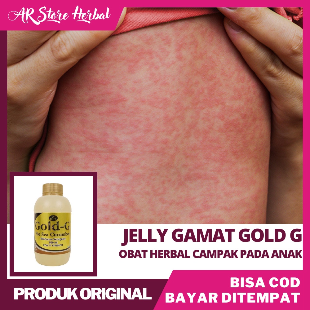 Obat Campak Bayi | Obat Gatal bayi Anak-Anak Balita Obat Eksim Obat Gatal Psoriasis Salep Jamur Kura