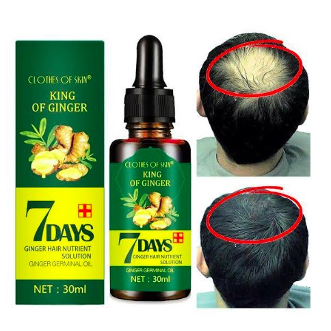 Essence Minyak Penumbuh Rambut Anti Rontok Obat kebotakan 7days Clothes Of skin Ginger