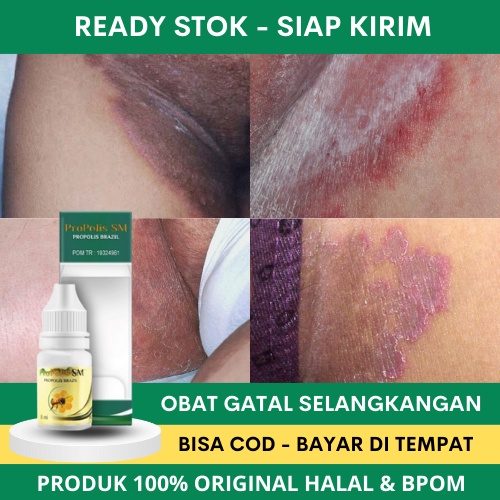 Obat Tetes Gatal Selangkangan, Obat Pembersih Jamur di Selangkangan, Obat Penghilang Hitam Gatal Sel