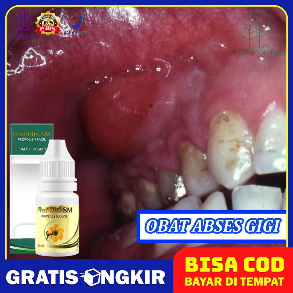 Obat Abses Gigi Perikoronitis Radang Gusi Periodontitis Plak Gigi Gingvitis Gusi Bengkak