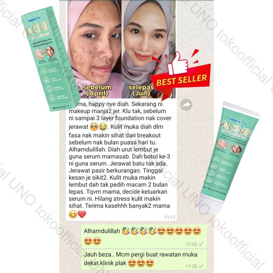 [HBESTY Impor] Cream jerawat Acne spot Salep jerawat Obat totol jerawat30G Menghilangkan bekas jerawat lama dan lubang jerawat peradangan kulit tak efek samping cream jerawat dan bekas jerawat ampuh