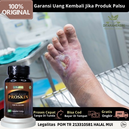 Obat Luka Diabetes, Obat Pengering Luka Diabetes Bernanah, Obat Herbal Luka Diabetes Basah, Obat Luk