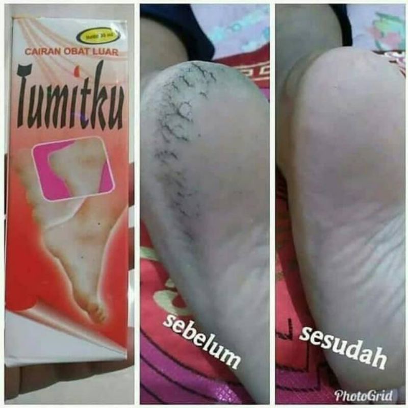 tumitku obat kaki kapalan dan pecah-pecah Original BPOM