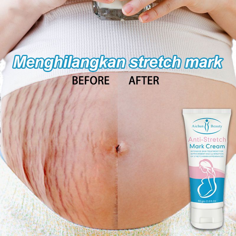 Strechmark Cream Krim Strech Mark Pascamelahirkan Krim Anti Strechmark Penghilang Bekas Luka Aman Untuk Bumil-60G