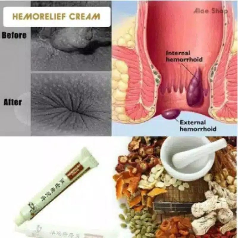 [ ORIGINAL ] Salep Obat Wasir Ambien Ampuh Ambeien Chinese Cina China Herbal Cream Anal anus Murah