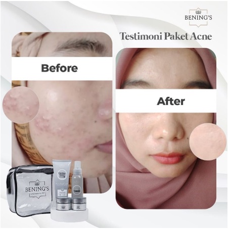 Benings Acne Series | Bening Skincare Doctor Oky Pratama