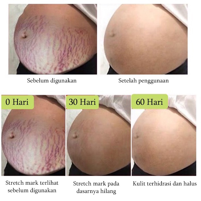 AICHUN Anti-stretch Mark Cream 60G - Strechmark Cream Krim Strech Mark Pascamelahirkan Krim Anti Strechmark Penghilang Bekas Luka