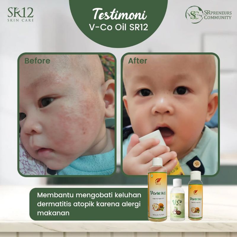 Obat Gatal Gatal Bayi - Ruam Popok - Bruntusan - Biang Keringat 100% Alami