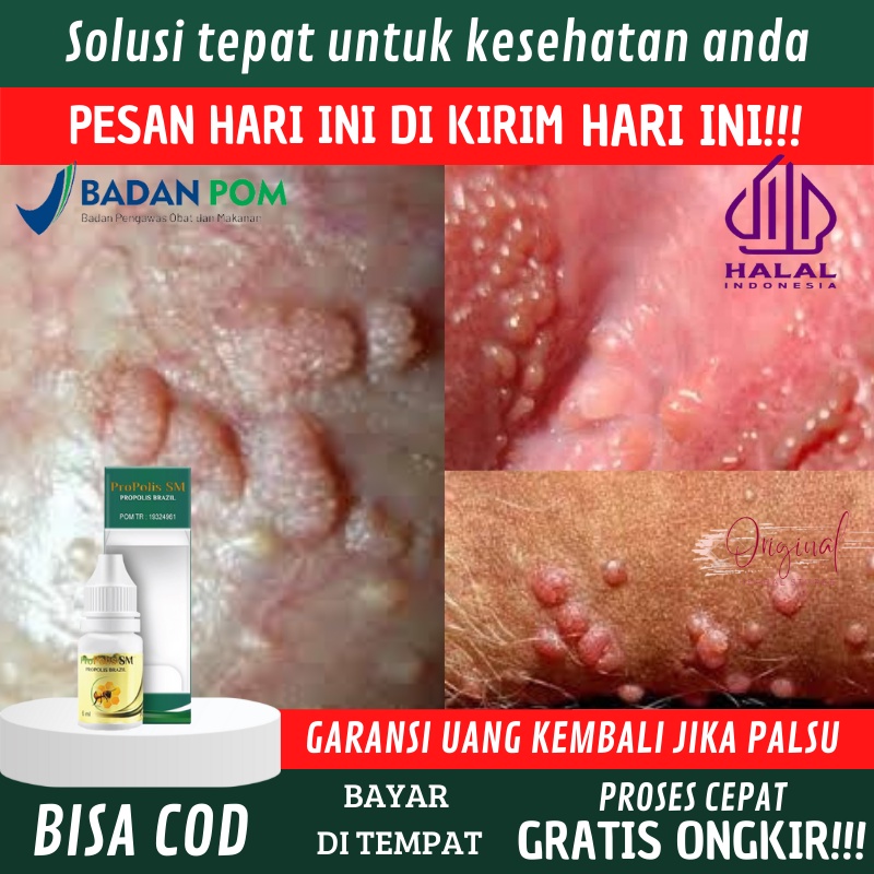 Obat kutil kelamin, Salep kutil kelamin, Obat gatal kelamin, Obat kutil kelamin wanita, Obat penyaki