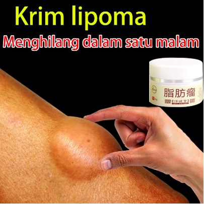 【ready stock】Krim Antitumor 30g Obat benjolan salep benjolan Obat Benjolan lipoma Benjolan di seluruh tubuh  Benjolan di Leher Benjolan Di Tangan Benjolan Di Ketiak Benjolan Di Punggung Pundak Benjolan Di