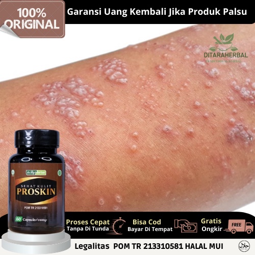 Obat Gatal Berair, Obat Gatal Kulit Berair, Obat Gatal Berair Menyebar, Obat Kutu Air, Obat Herbal G
