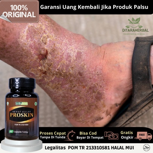 Obat borok bernanah, obat kulit borok, obat alami borok bernanah bau, obat penghilang borok di kulit