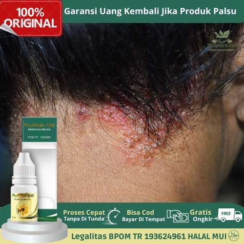 Obat Koreng Di Kepala, Obat Oles Luka Koreng Kulit Kepala, Obat Koreng Berjamur, Obat Borok Di Kepal