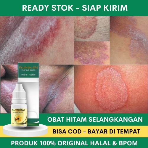 Obat Selangkangan Hitam - Obat Penghilang Selangkangan Hitam - Obat Selangkangan Hitam dan Gatal - O