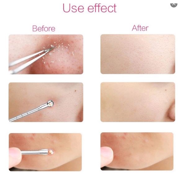 Alat Pinset Pencet Komedo Pembersih Jerawat Acne Blackhead 3 in 1