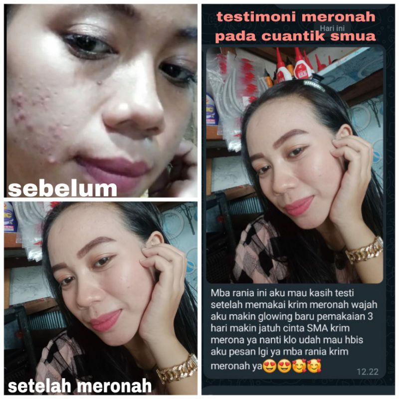 (NEW)SABUN JERAWAT, BERUNTUSAN, KOMEDO, WAJAH SENSITIVE ,WAJAH IRITASI AKIBAT GANTI GANTI SKINCARE ,FACIALWASH TERBARU