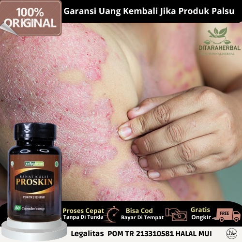 Obat Gatal Kulit Eksim, Obat Eksim Kering/ Basah, Obat Eksim Menahun, Obat Eksim Parah, Obat Jamur K