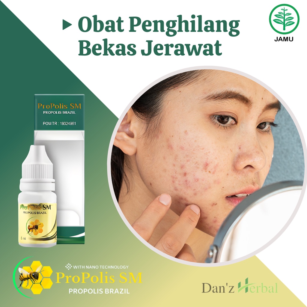 Obat Oles Penghilang Bekas Jerawat, Penghilang Bekas Jerawat di Wajah, Obat Jerawat di Badan, Penghi