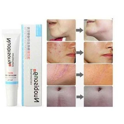 Nuobisong Gel Obat Penghilang Bekas Luka Jerawat / Selulit / Keloid ram02