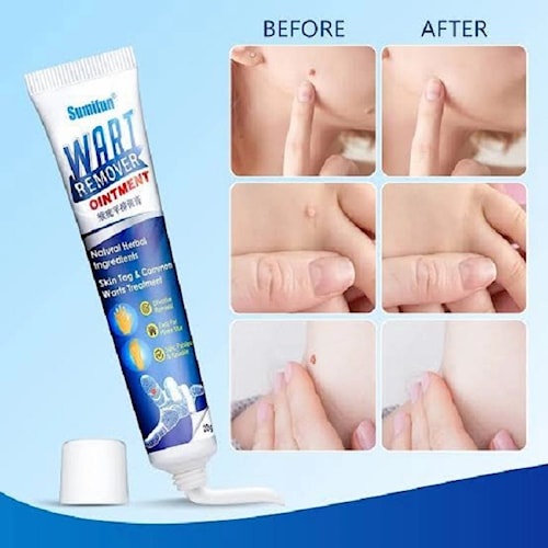 SUMIFUN  Salep Penghilang Tahi Lalat dan Kutil / SUMIFUN Wart Remover Oint