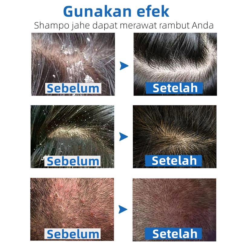 SADOER Sampo Anti Ketombe Ginger Shampoo / Conditioner / Hair mask /Hair Care Set Anti-hair loss Dandruff Frizz Fork Supple
