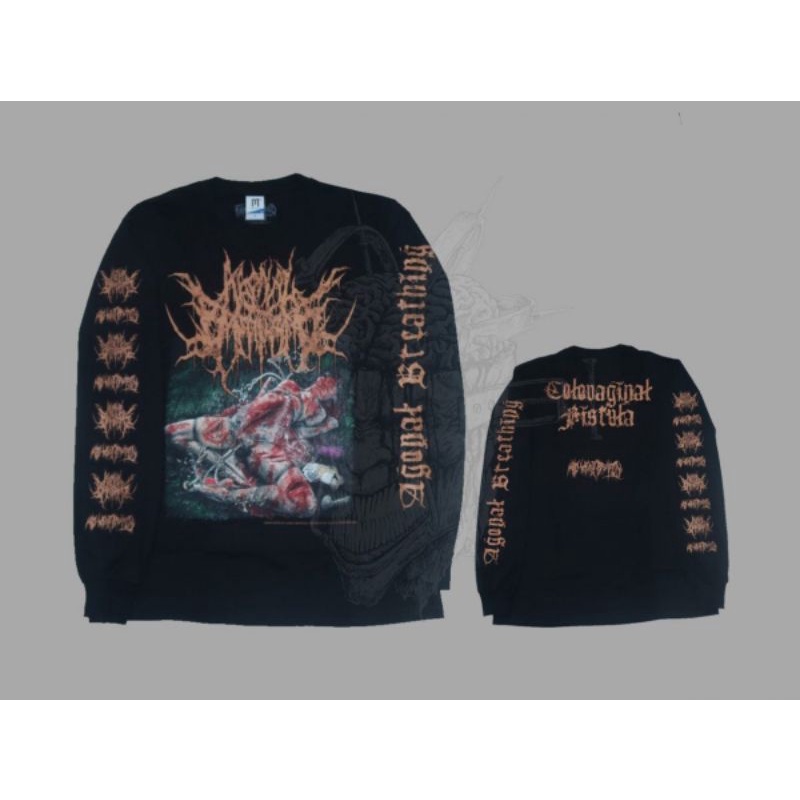 LS - AGONAL BREATHING - Colovaginal Fistula