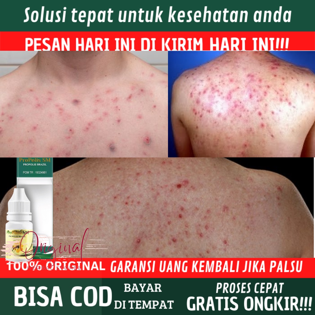 Obat Jerawat di punggung, Obat Jerawat punggung dan dada, Obat Jerawat Punggung, Salep jerawat Pungg