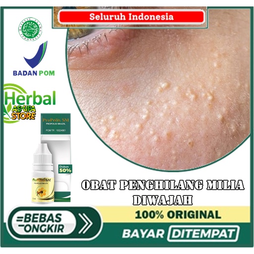 Obat penghilang milia diwajah, kulit, bruntusan, beruntusan, benjolan kecil, kelopak mata, bintik pu