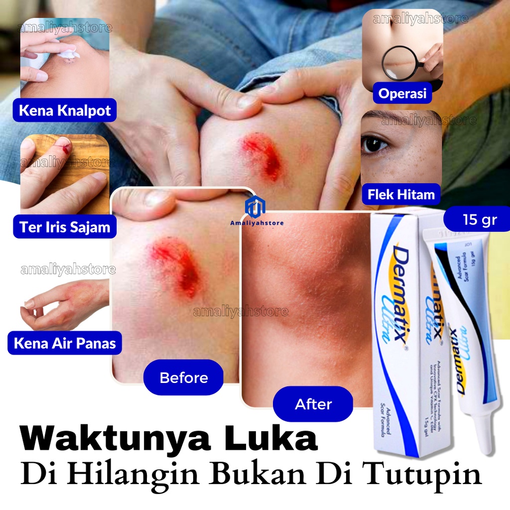 Penghilang Bekas Luka Hitam Koreng Di Kaki Yang Sudah Menahun Salep Cream Strechmark Bumil Dan Busui Obat Selulit Penghilang Bekas Luka Operasi Cesar Ampuh Bpom Dermatix Ultra Gel 15gr Original
