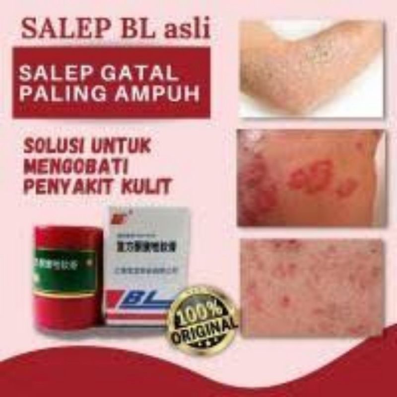 SALEP BL ORIGINAL 100% - salep gatel - jerawat - kudis -panu-kurap-salep gatal-saleb gatal-cream bl