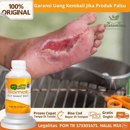 Obat Luka Diabetes Bernanah, Obat Luka Diabetes Gatal,  Obat Diabetes Basah, Obat Nyeri Luka Diabete