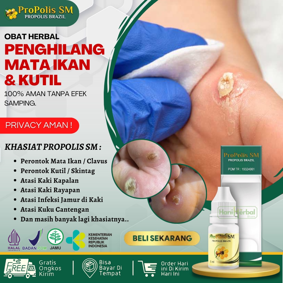 Obat Untuk Menghilangkan Mata Ikan, Kutil dan Kapalan, Obat Tetes Perontok Mata Ikan di Telapak Kaki
