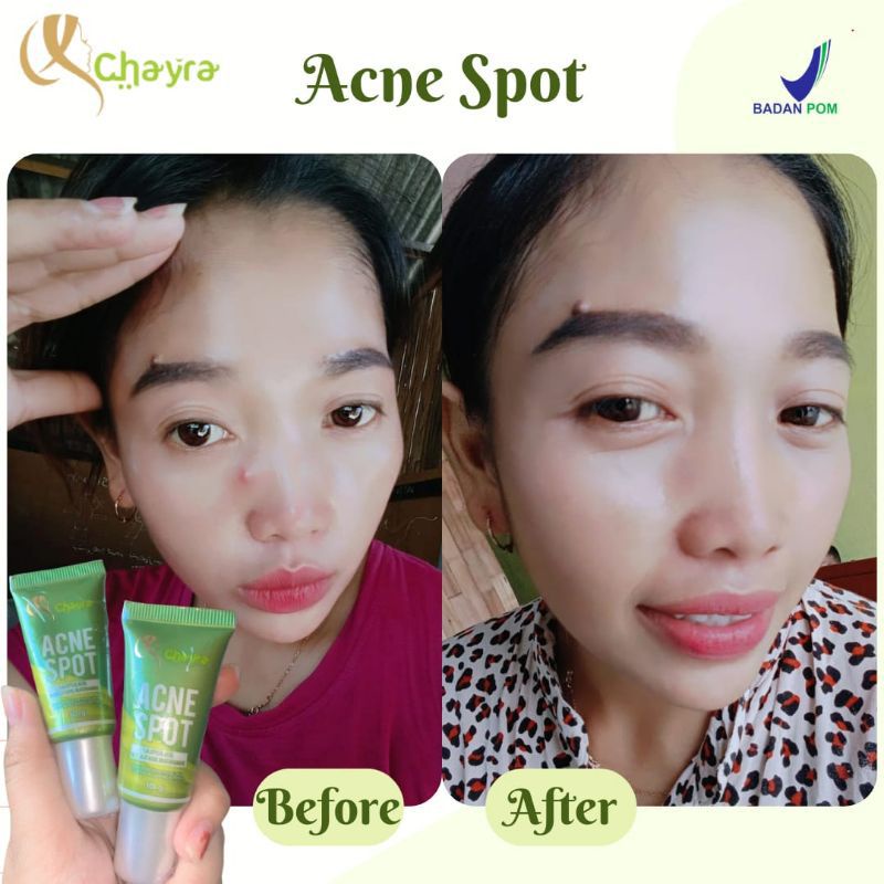ACNE SPOT ORLIN BEAUTY ORIGINAL