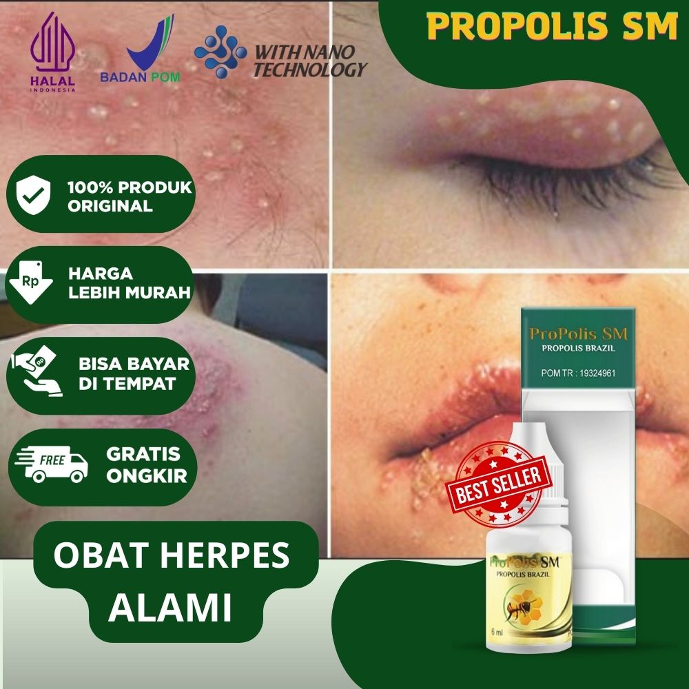 Obat Herpes Virus Herpes Penyakit Kulit Herpes Genital Simpleks Herpes Zoster Herpes Di Bibir Mulut 