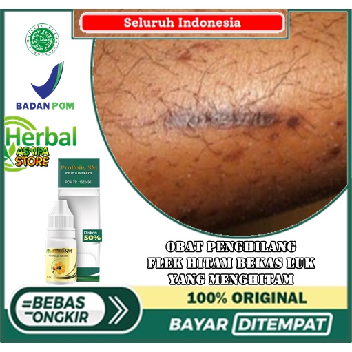 obat penghilang flek hitam bekas luka, yang menghitam, luka cakar, gatal, koreng hitam, bekas cakara