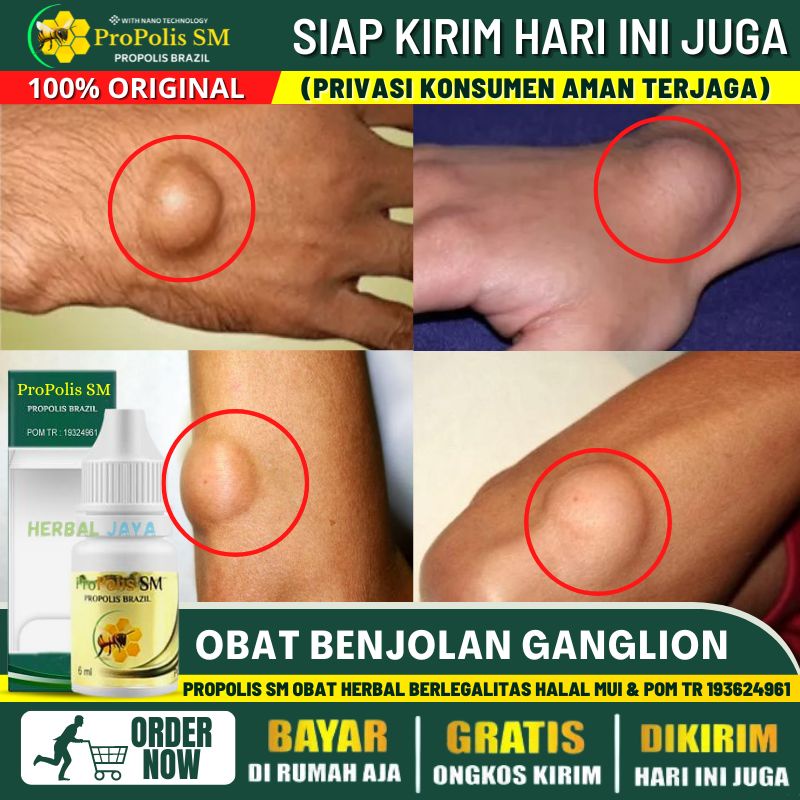 Obat Kista Ganglion Benjolan Keras Seperti Tulang di Tangan, Obat Benjolan di Sikut Tangan, Obat Ben